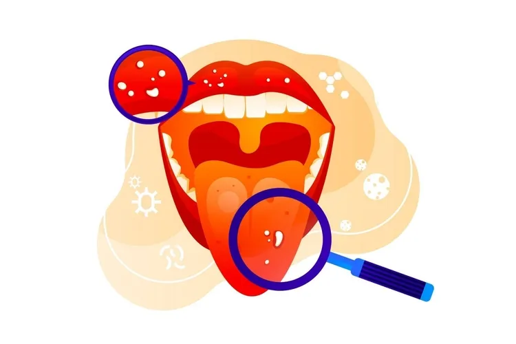 gambar Mulutmu,Kesehatanmu : Langkah-langkah Deteksi Kanker Mulut Secara Mandiri